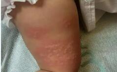 專家提醒：多重因素導致孩子過敏越來越常見