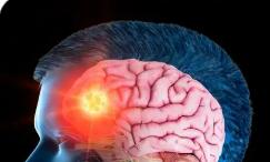 顯效率77.26% 覆蓋328縣 我國(guó)基層癲癇防治取得扎實(shí)成效