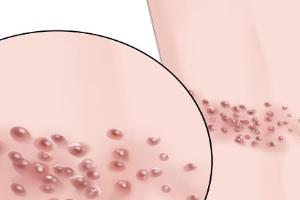 2026帶狀皰疹行動月：多方共倡“三高一疹”聯(lián)防